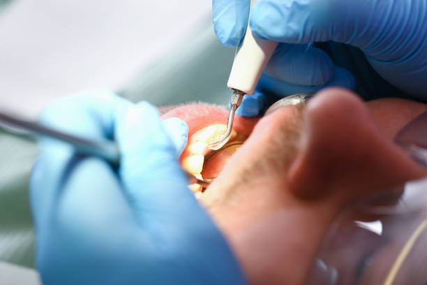 Best Dental Abscess Treatment in New Glarus, WI